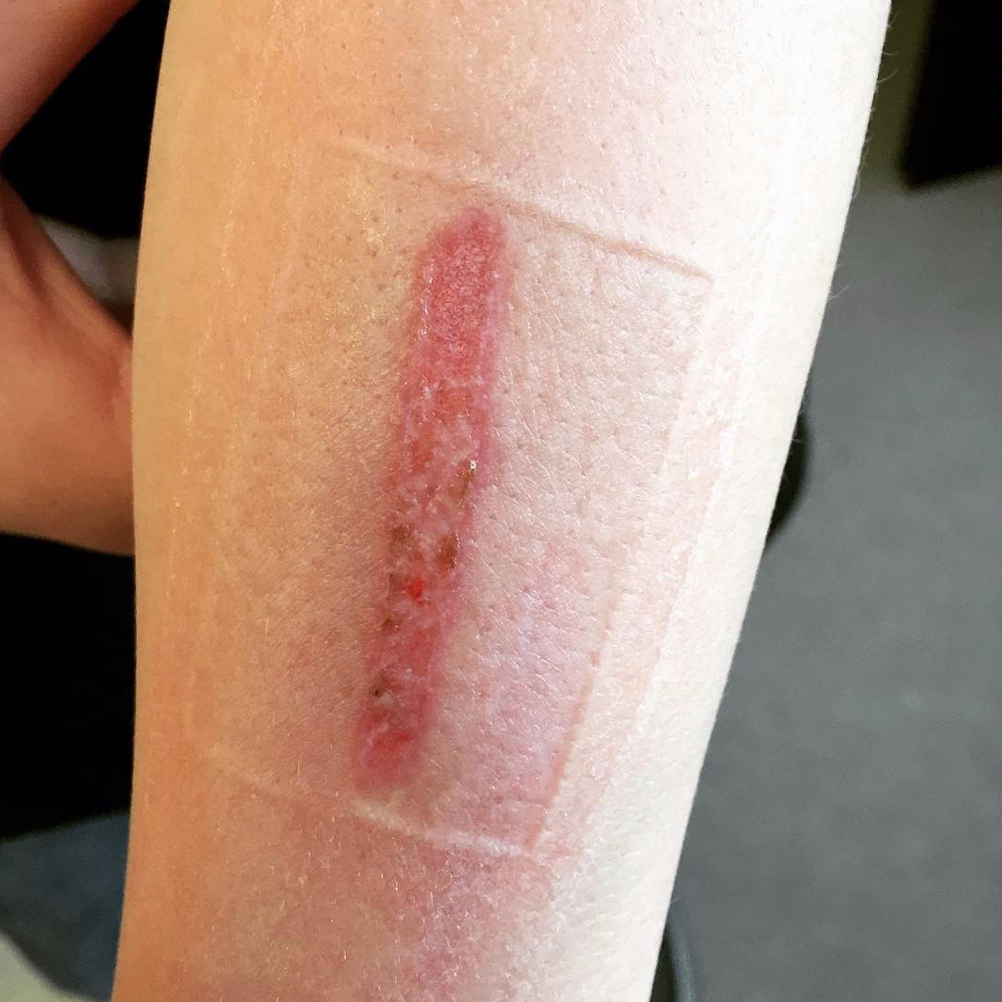 eraser challenger scar